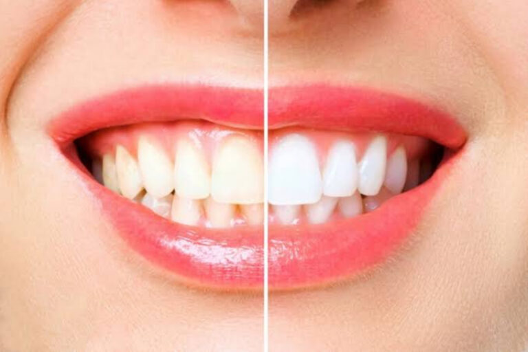 Home Remedy For Teeth Whitening